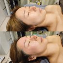 힐앤핏 | 왕십리 슈퍼젝션 관리로 얼굴 볼륨 채운 결앤핏 후기