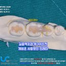 뉴세라믹치과기공소 | 길음역치과 인레이가격 순위를 매긴다면??