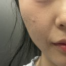 로터스구조 | [강남 에스테틱] 로터스에스떼 - 뒤집어진 피부 긴급 구조! 신논현웨딩케어 물광테라피 솔직후기 (feat...