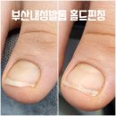 이뮤셀의원 | 내돈내산 재방문 부산내성발톱 홀드핀칭서면점 부산발톱무좀