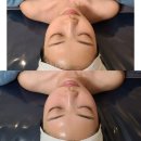 A1335 | 다대동 설레임에스테틱 피부도로공사에 슈퍼젝션까지 받고 온 후기