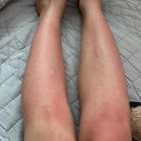 파크병원 | 워터파크 물놀이 후 두드러기 간지러움 알레르기 피부과 병원 다녀온 후기 연고 약 주사
