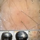 강서구-20 | 강서구 까치산 두피관리, 20대 중반 남성 정수기 탈모케어 후기 ( 5회차 )