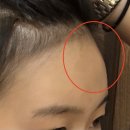 토마토피부과의원 | 청담 피부과 이마 필러로 울퉁불퉁한 이마 매끈하게 만든 후기 [내돈내산/통증/가격/유지기간]