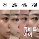 아이멍쥬 | 눈가 주름 때문에 쥬베룩아이 내돈내산, 강남역 성형외과 후기 용량 통증 멍 만족도