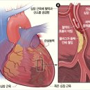 (후기) 심근경색, 죽음은 그리 멀리 있지 않다. 이미지