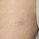 아문성형외과의원 | 등에 생긴 멍울, 치료 방법은? (멍울 핀홀법 수술 피지낭종 성형외과 서울)