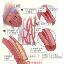 소리없이 가슴에 드는 멍 / 협심증 狹心症 이미지