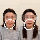 대구피부관리 제이라인코리아 칼 안 대고 당겨주는 울리프 에어젯 찐 후기!