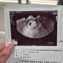 서연아이 여성의원 인공수정 3차 성공 후기 및 임신초기증상