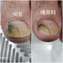 루덴네일