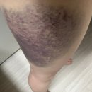 교대 허벅지 무한람스 가격 붓기는 1주후기 몰래도 가능함