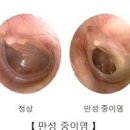 한쪽 귀가 먹먹할때 원인 및 치료 방법 이미지