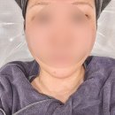 커피온다 | 온다리프팅 후기 볼살부자 탈출 강남피부과 가격 효과 총정리
