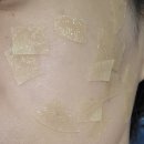 갤러리아피부과의원 | <갤러리아피부과 성북>내돈내산 Co2레이저 2주 후 최종후기with날짜별 초상세후기,듀오덤관리😆