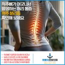 추정형외과의원 | 뒤로 젖힐때 아프다면 척추분리증!!::반월당정형외과,반월당도수치료,반월당근처병원 뽀빠이연합의원
