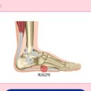 족저근막염 원인 발바닥 발뒤꿈치 통증 증상 주사 치료 방법 이미지