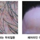 엠지에프두피탈모센터 이미지