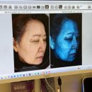 명성의원 | [광화문피부과] 광화문 테라스의원에서 흑자한번에 빼기_리팟레이저 후기 1차