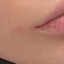 교하제일약국 | [임신중기]임신 저혈압 후 얻은 후유증/임신 동전습진/임신 접촉성피부염/임산부 소양증