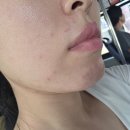 올리브영 군산수송점 | [군산피부관리 여드름 압출] 수송동 감동스킨앤네일...근막테라피’로 지성 피부 붉은 기 순삭 정착 후기 ✨