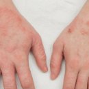 알레르기 이미지