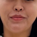 볼다 | 40대 무너진얼굴 실리프팅 후기 (팔자+턱라인개선!!)