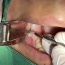 연세그린이치과의원 | [아산 연세원치과]"사랑니 뽑고 혀 감각이 이상해요" CT에도 안 보이는 '설신경' 보호가 중요한 이유