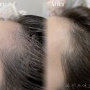 빈 헤어라인