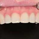 아름다운미소치과의원 | 김포치과 라미네이트, 자연 치아 보존하며 아름다운 미소 그리기🦷