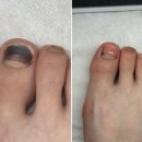 답십리 문제성발 [오라네일 오로지푸스 답십리점] 발톱 혈종 케어 후기