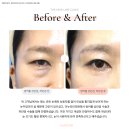 시티성형외과의원 | 상안검 하안검 수술 전후 사진, 지웰시티 근처에서 한달 만에 회춘한 후기 / 청주성형외과