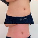 뮤 | 대전 슬리밍 복부라인 달라진 아로뮤에스테틱 후기