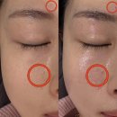 [양주 피부] 로덱스스킨앤왁싱에서 잡티 제거로 환해진 피부, 후기 공개