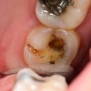 중앙치과재료상사 | 평택 치과, 밤새 욱신거리는 어금니...발치 권유 받기 전 꼭 읽어보세요