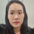 [강남 신사역] 🎀리본성형외과🎀 30대 중안부, 심부볼 실리프팅 내돈내산 후기