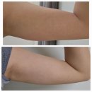 블루밍의원 | 을지로입구역 지방분해주사 후기 블루밍의원 일주일차, 한달 뒤 7cm 감량