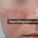 수로한의원 | 주사피부염 한의원 심부재생치료 후기 (신사역)