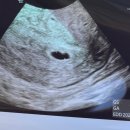 유니한방병원 | 산전검사부터 임신 극초기 증상~임신 1분기(1~12주차) 초산모 증상