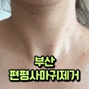 진 | 부산 편평사마귀 편평사마귀제거 재생테이프 없이 얼굴 목 깔끔해진 후기