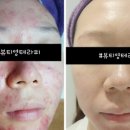 영테라피 이미지
