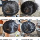 여름의원 | 당진 제일의원 탈모약 후기(효과,부작용,가격,여름휴가,휴진)