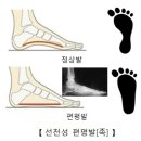 선천성 편평발[Congenital pes planus [flat foot]] 근골격질환 이미지