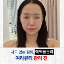 동탄기흥로 | 여라뷰티 자극 없는 필링 찾다가 선택한 애씨큘관리, 동탄피부관리 후기