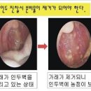 인후통 효능 및 증상 원인 침삼킬때 목아픔 이미지