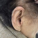 세종메디칼 | 세종보청기 상담 후 포낙 인피니오 Audeo I30-R 오른쪽 착용 후기