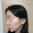 이미지업의원 | 신사 요정귀필러 후기맛집 귀필러 리터치 후기｜귀필러 2cc 양쪽, 귀 모양 교정으로 더 또렷해진 변화❤️