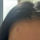 더올린의원 | 논산 피부과 [더올린의원 클리닉] 후기/ 여드름 염증 주사