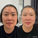 대구리프팅 잘하는 곳 아미뷰티센터 티리온X 후기
