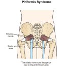 Piriformis Syndrome(이상근 증후군) Rehabilitation Exercises 이미지